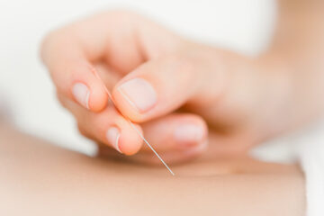 Dry Needling